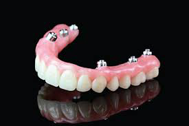prótesis híbrida dentistas Bilbao